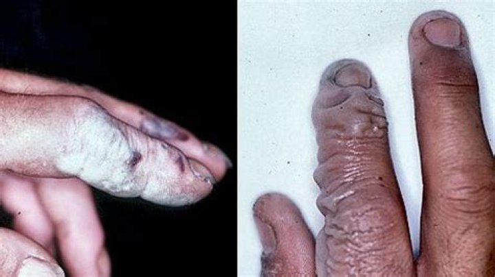 Alkaline Battery Acid On Skin