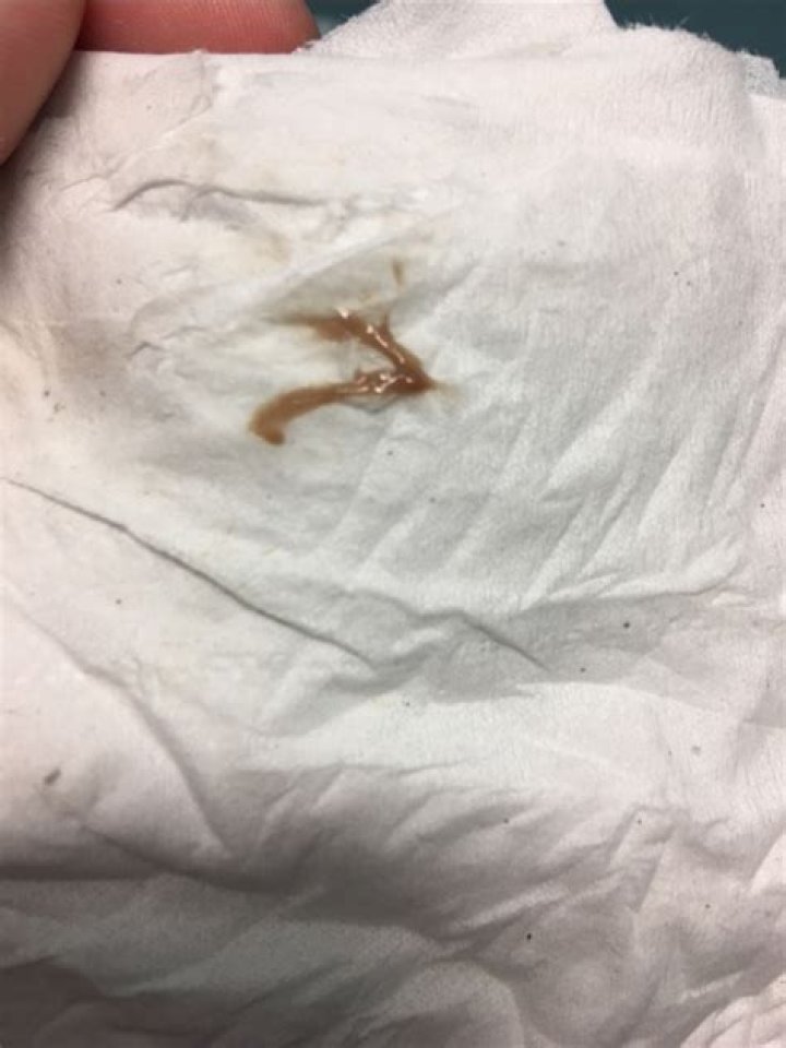 Brown Discharge After IUD Insertion