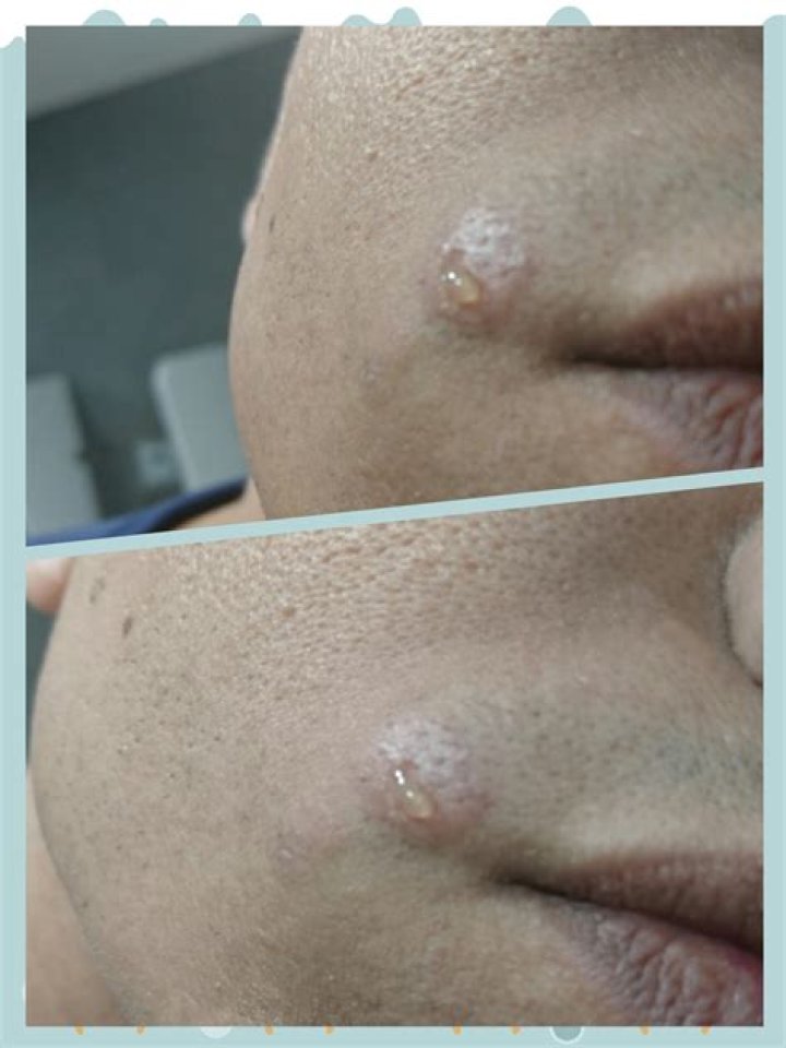 Bump With Clear Liquid Coming Out