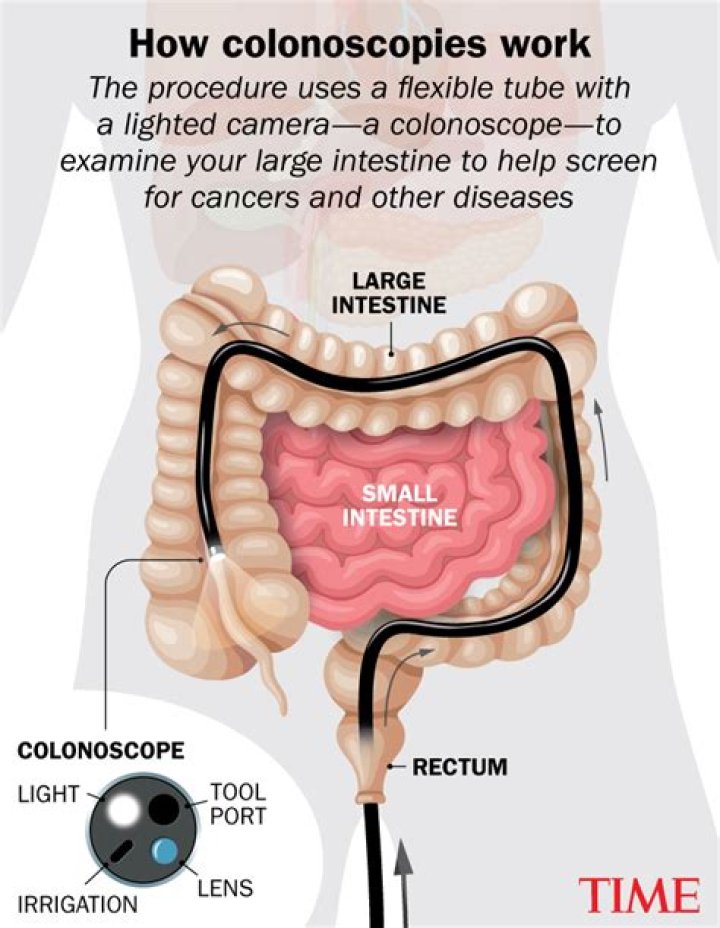 Can a Colonoscopy Make a Rectocele Worse? Exploring the Relationship Between Colonoscopy and Rectocele