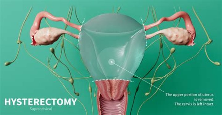 Can Your Uterus Grow Back After A Partial Hysterectomy