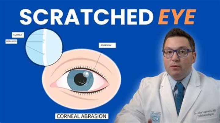 Cat Scratched Your Eye? Here's What to Do!