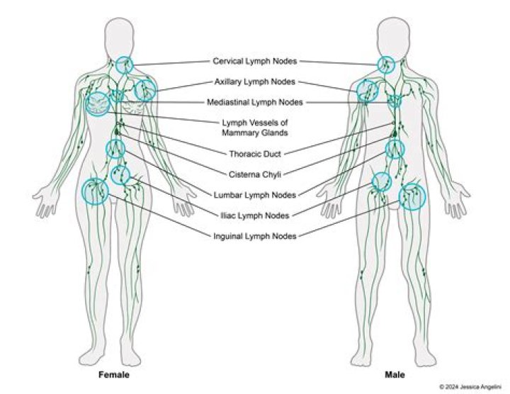 Do Necrotic Lymph Nodes Need To Be Removed