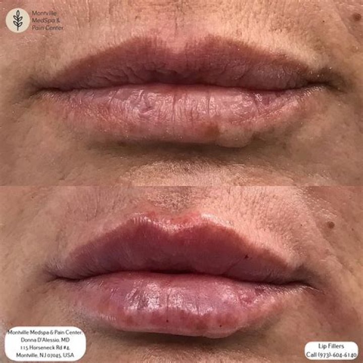 Do we... underappreciate filler too much?