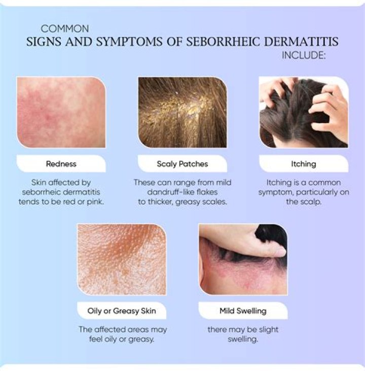 Drugstore Sebbhoreic Dermatitis Routine That Works