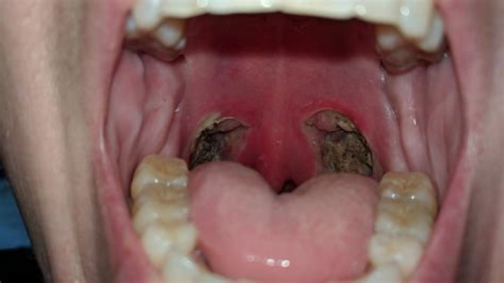 Hole In Throat After Tonsillectomy