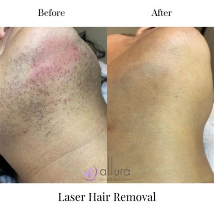 How Long Does Laser Hair Removal Last?