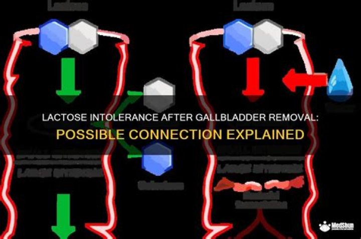Lactose Intolerance After Gallbladder Removal