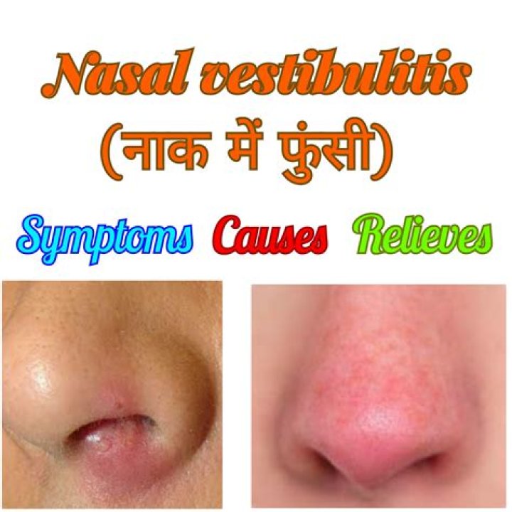 Nasal Vestibulitis Images - Statcare