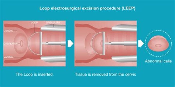 What Happens When a Scab Falls Off After a LEEP Procedure